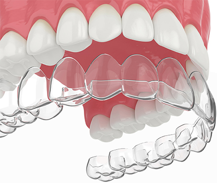 Invisible Braces - Rainier Valley Orthodontics