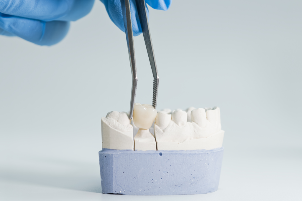 Loose Dental Crown