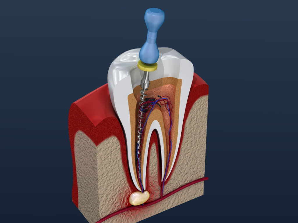 Benefits of Root Canal Treatment - River Valley Smiles