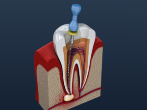 Benefits of Root Canal Treatment