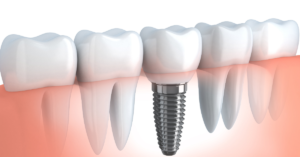 Facts About Dental Implant Recovery Process