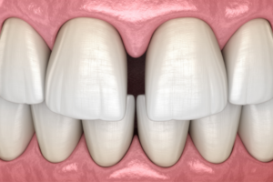 Four Kinds of Teeth in Your Mouth