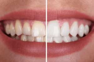 How to Whiten Teeth at Home