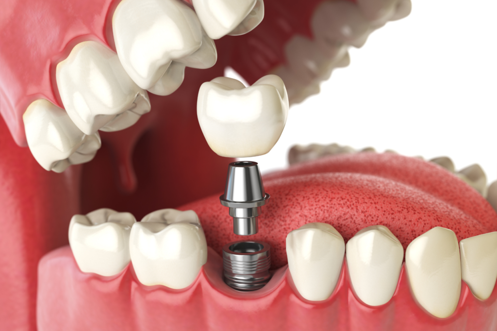 Signs of Dental Implant Failure and How to Prevent it from Happening