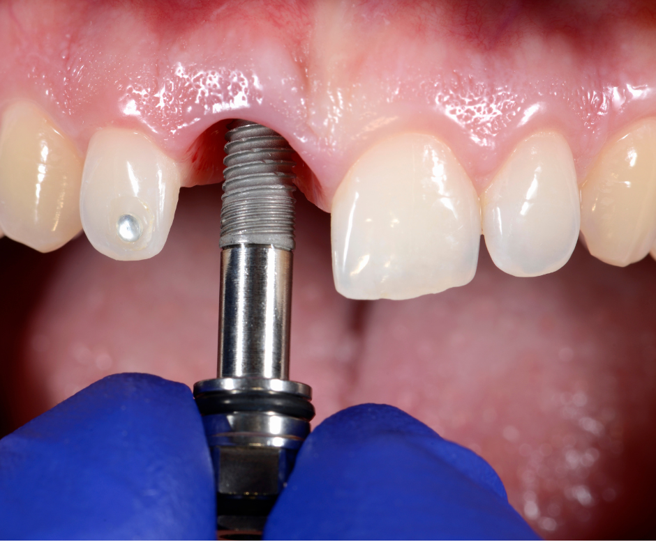 Why dental implants might not be a good idea