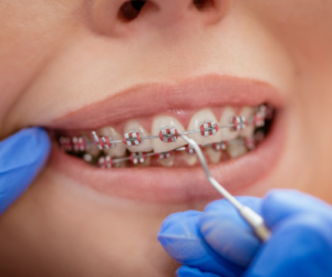 Medical Benefits of Dental Braces