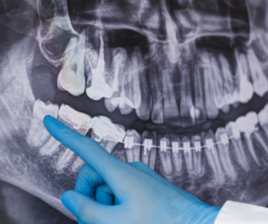 When Should You Get Wisdom Teeth Removed