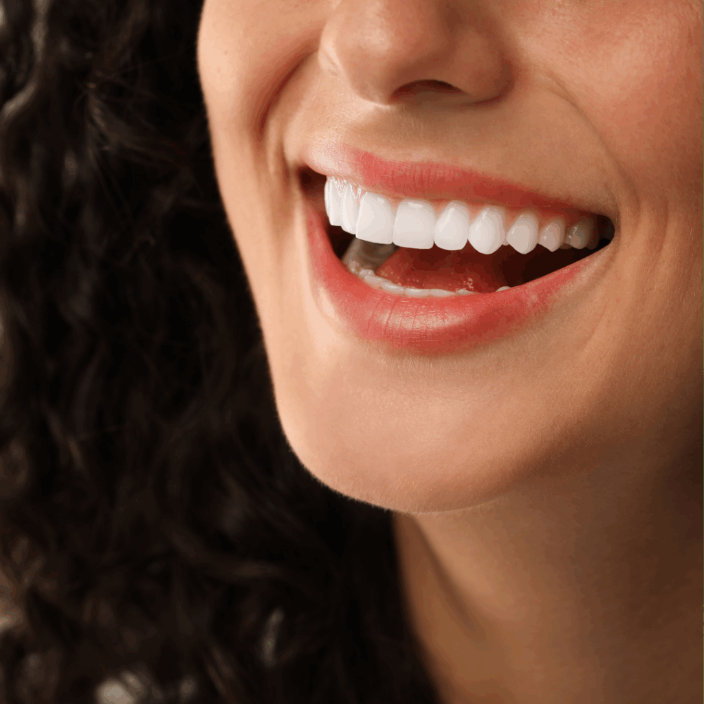 veneers