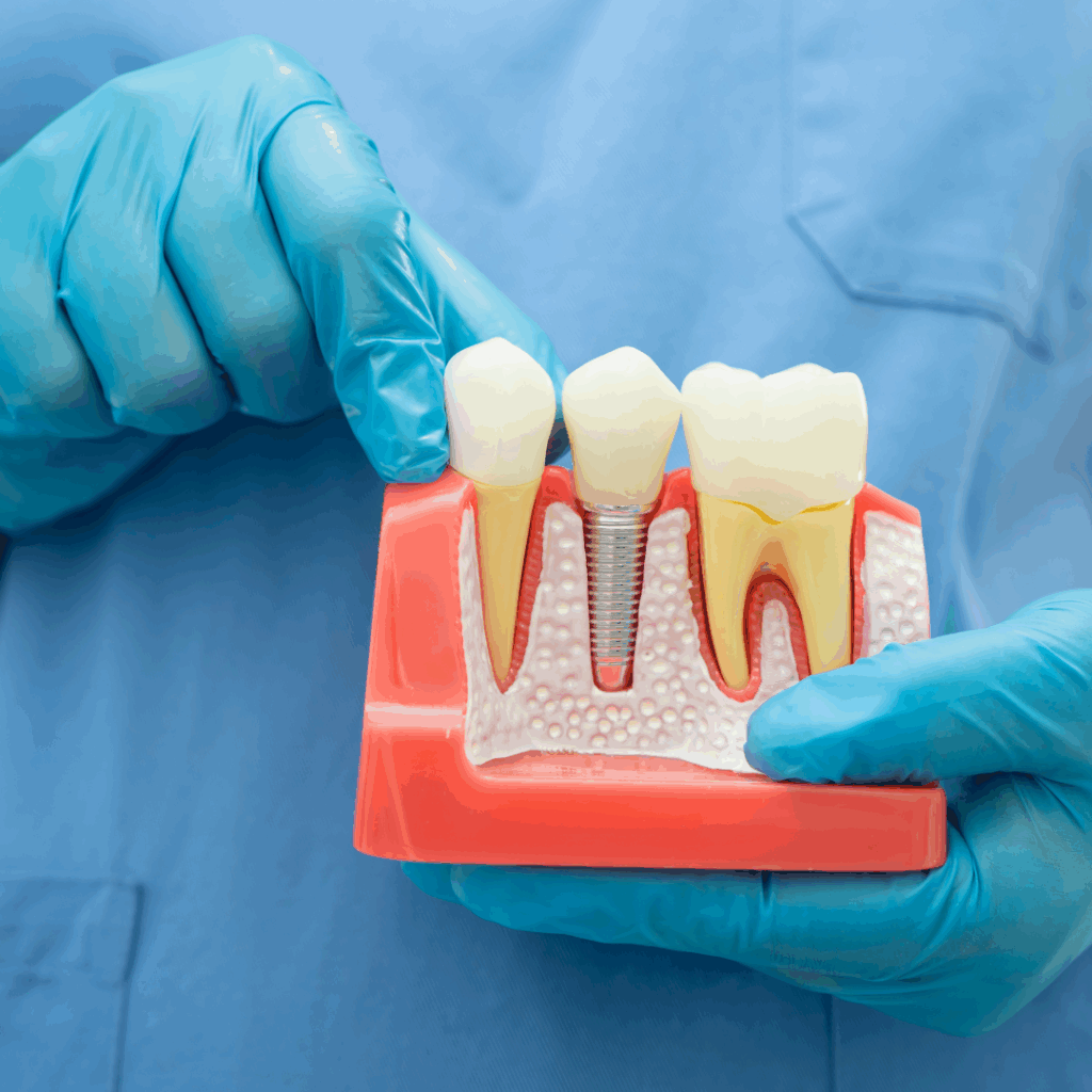 Root Canal