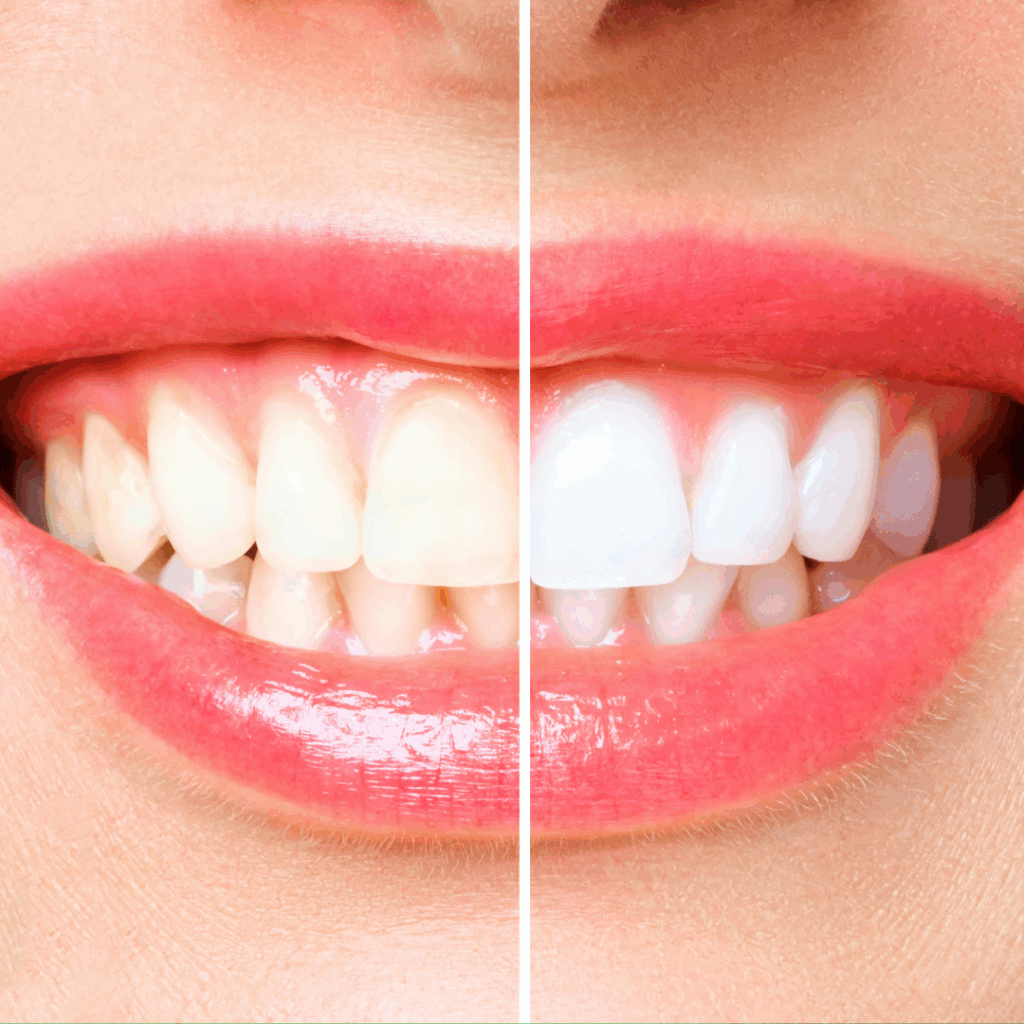 teeth whitening