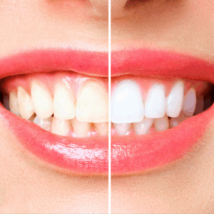 teeth whitening