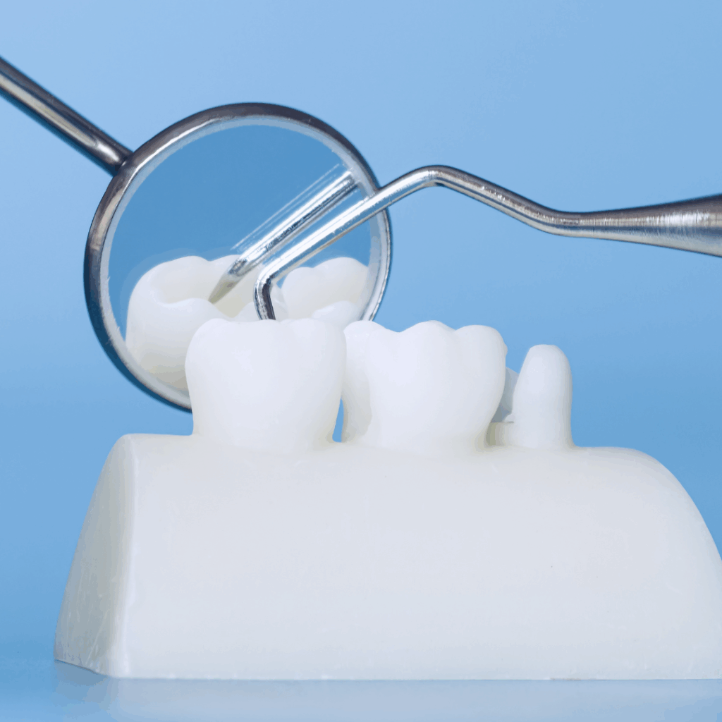 dental bridge