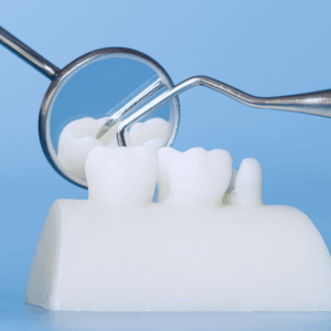 dental bridge