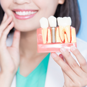 dental implants