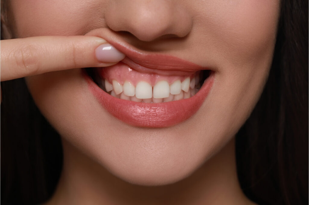 bleeding gums